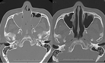 図：術前術後の副鼻腔CT画像（空気は黒くうつります）