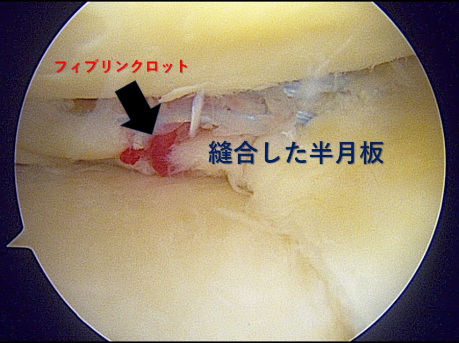 縫合した半月板です。当院では状況に応じてフィブリンクロット（手術中に採取した血液を固めて血餅を作り、断裂部に挟み込む）を併用しています。フィブリンクロットは成長因子を放出し、血流の悪い半月板の修復を助けます。
              