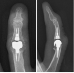 術後。人工関節に置換し指が伸びました