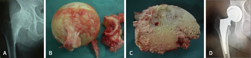 変形性股関節症のレントゲン像（Ａ）と骨頭表面（Ｂ）および断面（Ｃ）、ＴＨＡ術後（Ｄ）