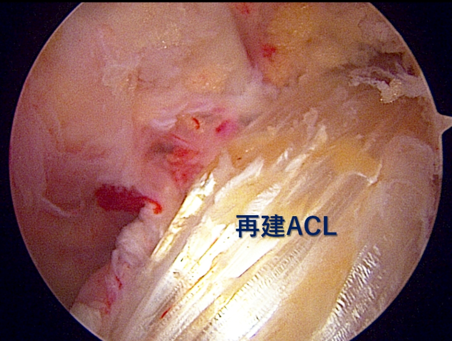 再建した前十字靭帯です。移植腱を正しい位置に固定して再建します。