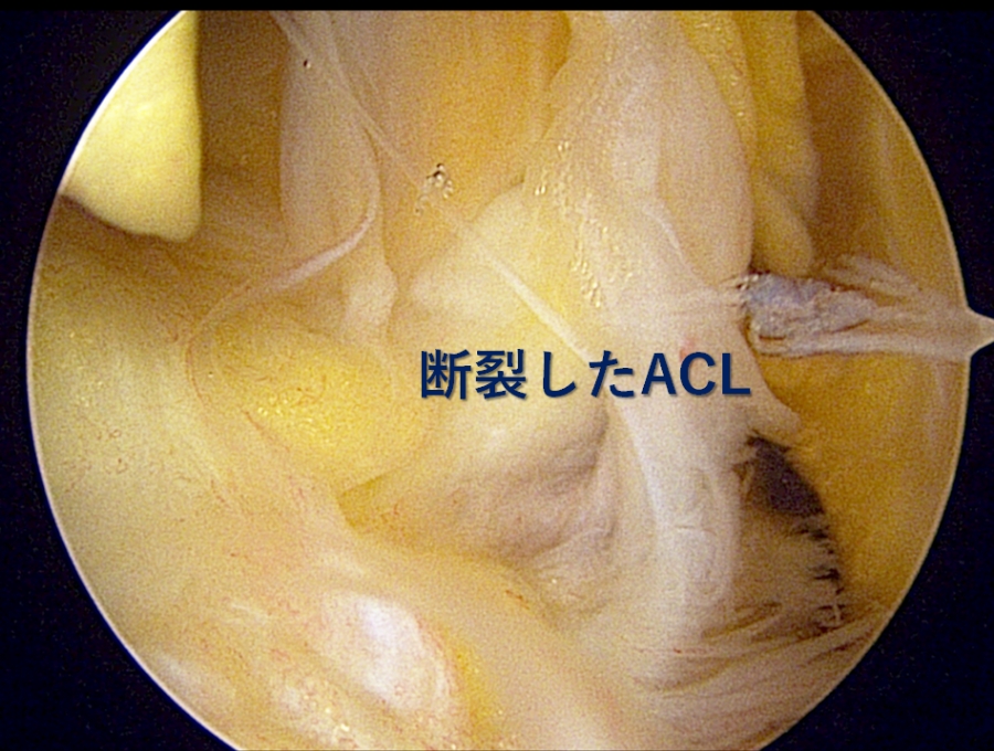 断裂した前十字靭帯です。断裂により靭帯の連続性がありません。
