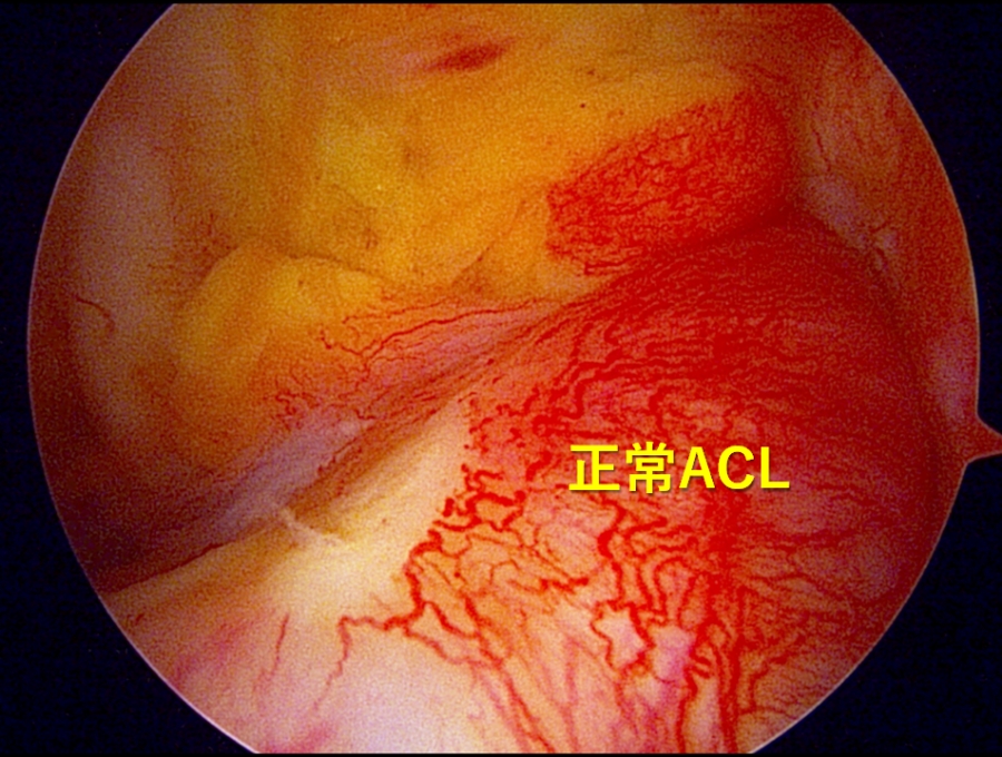正常な前十字靭帯（ACL）です。